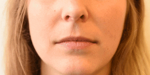 AU16 lower lip depressor