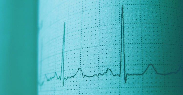 graph of an electroencephalography readout