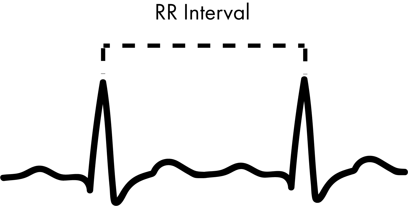  RR interval