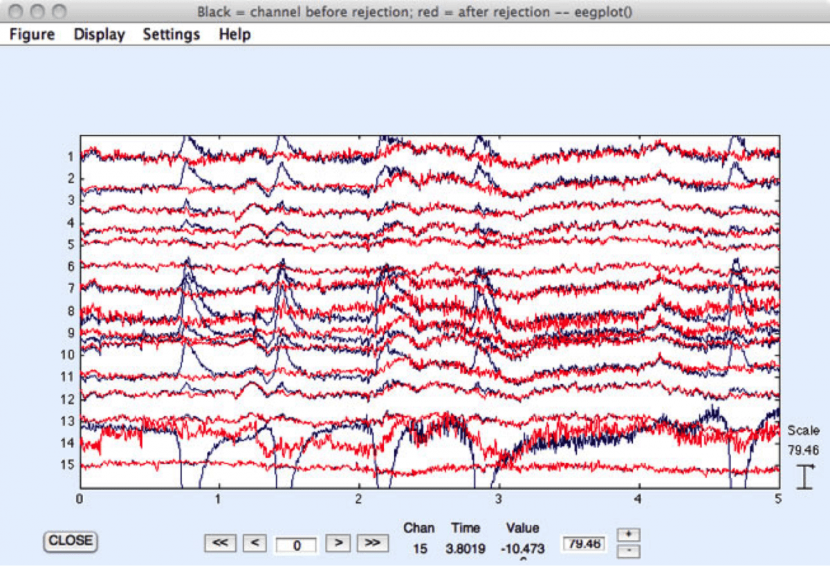 EEG artifacts