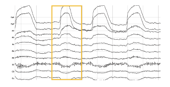 blinks and eeg